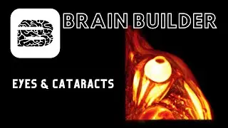 Eyes and Cataracts | Case Study