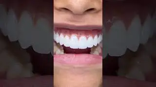 For upper new ceramic with tissue!