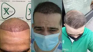 Tres INJERTOS capilares - NO HA PODIDO SER