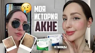КАК Я ВЫЛЕЧИЛА АКНЕ | Ретиноиды | побочные эффекты | Моя история