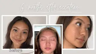 6 MONTHS POST-ACCUTANE