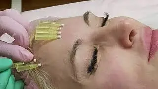 Введение мезонитей в область межбровья