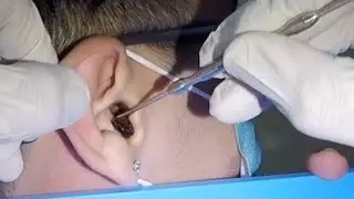 Removing  Man's  Big Black Earwax | It's STUCK!