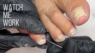 Gentle salon pedicure for mature feet. Involuted nails cut too short.  [Watch Me Work]