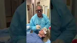DERMABRASION FOR LIP LINES- PART 1