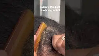 Extreme Dandruff Scratching ASMR Subscribe to see full video! Yall asked and I delivered!
