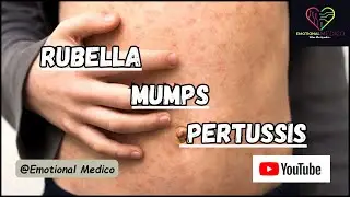 Rubella | Mumps | Pertussis | Community medicine