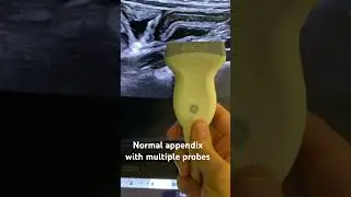 Normal Appendix with multiple probes