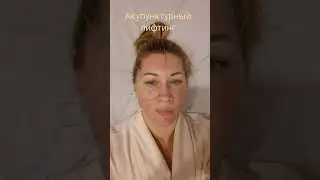 Акупунктурный лифтинг