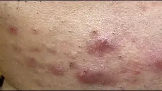 Jawline Acne #HoangMySpa120