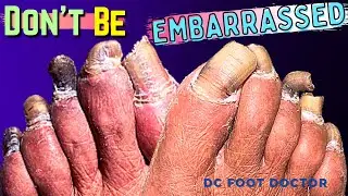 Don't Be Embarrassed: Toenails Trimmed After Many Years of Being Embarrassed About Her Feet