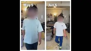#Duchenne #musculardystrophy treatment result after 2 months