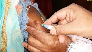 IM Intramuscular Arm injection Push. Triamcinolone  injection Video.  24 Ep 111 Anik Health Tips