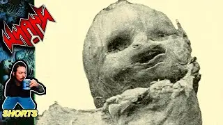 Woman Carries Fetus for 60 Years- Internet Shorts