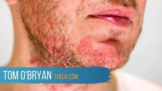 Dermatitis Herpetiformis: A Gluten-Related Disorder - Dr. Tom O'Bryan