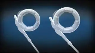 How Does Lap Band Surgery Work? Texas Laparoscopic Consultants
