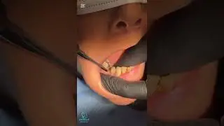 Extraction of lower premolar remaining root
