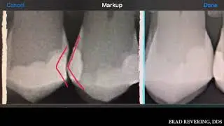 Why does food get stuck in your teeth after you get a filling?