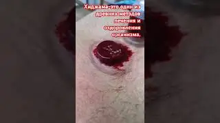 #hidjama