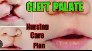 CLEFT PALATE || CARE PLAN #nursingstudent #nursingschool #education #medical #gnmnursing #careplan