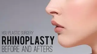 Rhinoplasty Patient Before and Afters