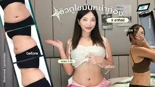 รีวิวประสบการณ์ดูดไขมันหน้าท้องที่ The Klinique เอวลด 3 นิ้วช้ำหรือบวมมั้ย? | mildnitha