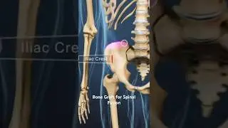 Bone Graft for Spinal Fusion