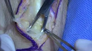 Radial forearm free flap (RFFF) harvest