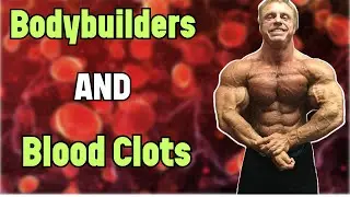 Why Do Bodybuilders Get BLOOD CLOTS? | Steroids and Blood Clots | Doctor's Analysis