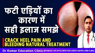CRACK HEEL PAIN AND BLEEDING NATURAL TREATMENT//फटी एड़ियों का कारण में सही इलाज समझे