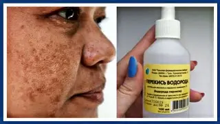 🔥 Смешайте ПЕРЕКИСЬ 🔥 Фарфоровая кожа в 70! От пятен и морщин рецепт для лица.