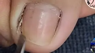 kuko nakadikit na masakit