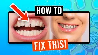 How Do Braces Fix Gaps?