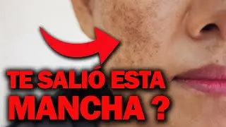 Melasma or chloasma? 🔥 Facial spots: Why do they appear? 🤔😱