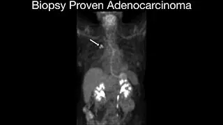 Biopsy Proven Adenocarcinoma
