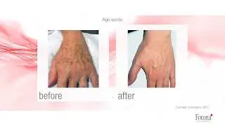 Pigments Laser Treatment