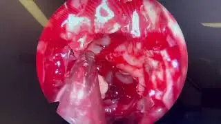 #healthtourismturkey #healthtourismizmir#sinussurgery#sinüzit#osteoma#osteom#sinuspolyp#sinüzit