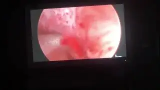 Isthmocele and polyp treatment with Bigatti Shaver