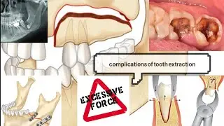 complications of tooth extraction_ مضاعفات خلع الاسنان