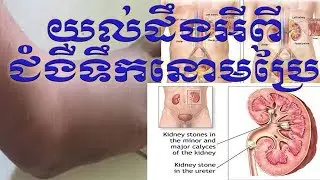 nephrotic syndrome ជំងឺទឹកនោមប្រៃ បកស្រាយដោយ វេជ្ជបណ្ឌិត រិទ្ធ សុវណ្ណារ់ា