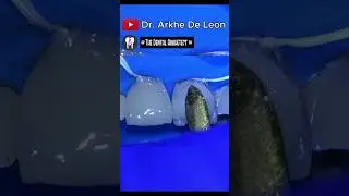 SIMPLE RESTORATION OF A ROOT CANAL TREATED TEETH (PART 2) 