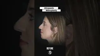 Ultrasonic Rhinoplasty Before & After #shorts