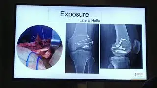 Hoffa fracture