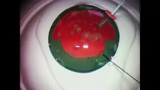 SimulEYE Capsule Support with Iris Hook