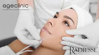Векторный лифтинг RADIESSE