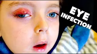 LITTLE BOY WITH KRABBE DISEASE BATTLES EYE INFECTION | Dr  Paul