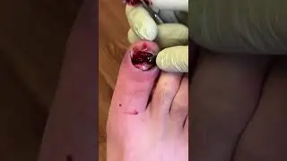 Toenail Injury