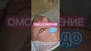 ОМОЛОЖЕНИЕ ДО