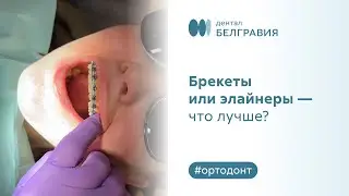 ➡ Брекеты или элайнеры - что лучше?