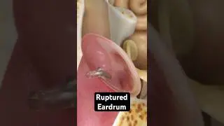 How does an eardrum rupture? (3D Animation)